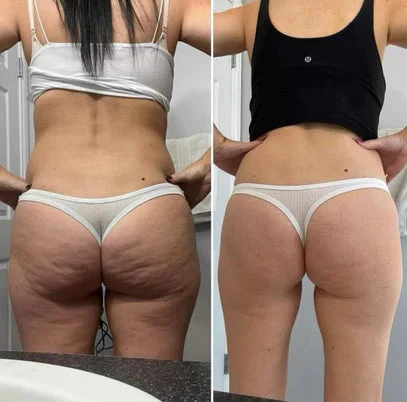 3D Anti-Cellulite Shorts — The Legging Effect Without the Heat + FREE Leggings 🎁